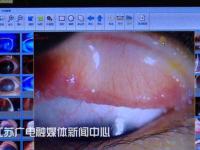 14岁少女戴网购隐形眼镜，感染寄生虫差点失明